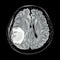 MRI brain : show brain tumor