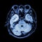 MRI brain : show lower part of brain