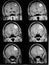 Mri of brain showing brain tumor