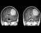 Mri of the brain showing tumor