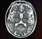 Mri brain stroke