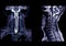 MRI of  C-spine or magnetic resonance image of cervical spine sagittal view  for diagnosis spondylosis causing cervical