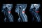 MRI OF CERVICAL SPINE : Moderate to severe posterior central disc protrusion of C3/4 to C5/6  intervertebral discs with a 2.0 cm