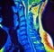 Mri of cervical spine stenosis