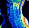 Mri of cervical spine stenosis