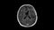 MRI examination of a male patient with a partially resected brain tumor