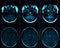 MRI head scan on dark background blue color. X-ray medicine and medication concept