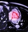 MRI heart or Cardiac MRI magnetic resonance imaging of heart showing aortic valve .