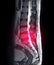 MRI L-S spine or lambar spine sagittal T2 technique for diagnosis spinal cord compression