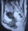 Mri large ovarian cysts radiological exam