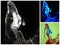 Mri left thumb sarcoma colorful collage