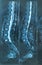 MRI Lumbar spine