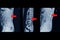 MRI of lumbar spine History of fall with back pain, radiate to leg, rule out spinal stenosis .Impression:Burst fracture of L2