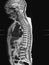 MRI of lumbar spine  the study reveals burst fracture of L2 vertebral body