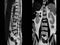 MRI of lumbar spine  the study reveals burst fracture of L2 vertebral body