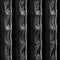 MRI Of Lumbar And Thoracic Vertebral Column
