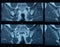 MRI sacroiliac articulation. Study of ankylosing spondyloarthritis patient