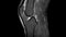 MRI Scan of left knee with ligament rupture