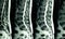 MRI scan of lumbar spines