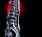 MRI scan of lumbar spines of a patient finding Spinal mass at Lt.side T12-L1 level Severe bulging disc L3-4 causing bilateral L4