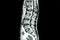 MRI scan of lumbar spines of a patient with kyphosis and back pa