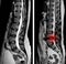 MRI scan sagittal view Lumbosacral spine has straightening lumbar alignment, L5-S1