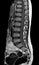 MRI spine showing mass at distal cord and conus medullaris, with tumor seedings at lower spinal canal. The mass appear hypersignal