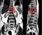 MRI Thoracic lumbar spine show moderate pathological compression fracture of T12 level