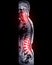 MRI whole spine screening for diagnosis spinal cord compression