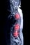 MRI whole spine screening sagittal T2 .