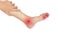 Multiple foot joints inflammation. Concept of rheumatoid arthritis, polyarthritis, gout, toe joint swelling or arthralgia