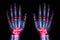 Multiple joint arthritis both hands ( Gout , Rheumatoid ) on black background