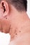 Multiple mole on neck and shoulder of Asian male