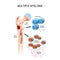 Multiple myeloma. plasma cell myeloma