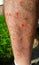 Multiple nasty mosquito bite on leg