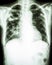 Mycobacterium tuberculosis infection (Pulmonary Tuberculosis)