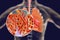 Mycoplasma pneumoniae bacteria in human lungs