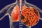 Mycoplasma pneumoniae bacteria in human lungs
