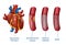 Myocardial infarction. 3d Realostic Stent in Heart