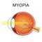 Myopia. Myopia is being short sighted.