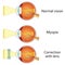 Myopia and myopia corrected by a minus lens.