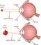 Myopia and normal vision