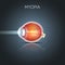 Myopia, short sighted eye