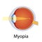 Myopia and Vision Disorders Illustration. Eyes Defect Concept. Detailed Anatomy Eyeball with Myopia Defect. Isolated