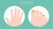 Nail diseases. Onychomycosis, nail fungal infection causes, treatment icon set. Medical infographic design