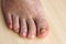 Nail fungus on the toenails and skin spots