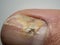 Nail infections caused by fungi such as: onychomycosis also known as tinea unguium. Thumb infection