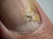Nail infections caused by fungi such as: onychomycosis also known as tinea unguium. Thumb infection