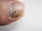 Nail infections caused by fungi such as: onychomycosis also known as tinea unguium. Thumb infection