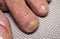 Nail infections caused by fungi such as: onychomycosis caused by dermatophytes and yeasts and for the concomitant antibacterial